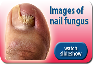 Watch images of fungal nails