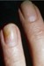 fungus in fingernails