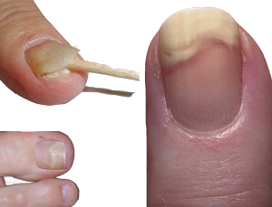 What is onycholysis or nail lifting? - Sharecare