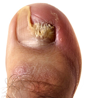 Vicks+vapor+rub+toenail+fungus